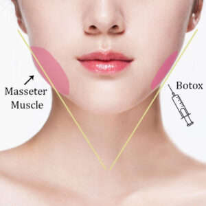 BOTOX MASSETER AUSTIN 