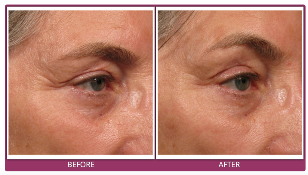 Brow Lift