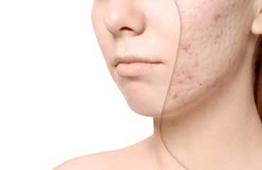 acne scarring