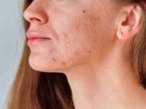 ADULT ACNE TIPS