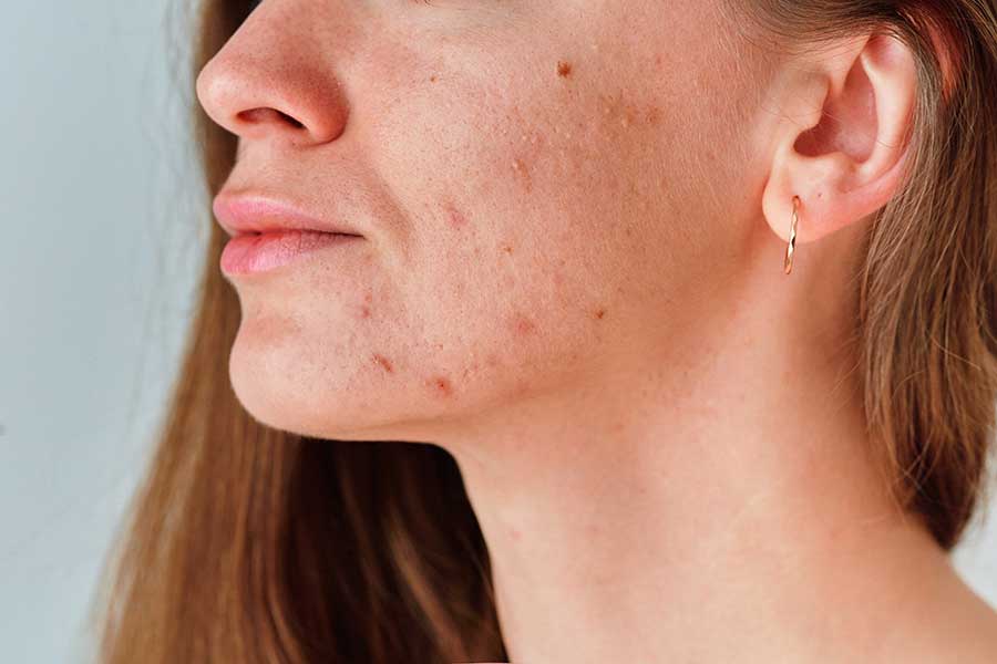 adult acne treatments in austin beaux medspa