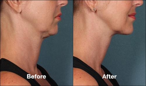 KYBELLA FOR DOUBLE CHIN