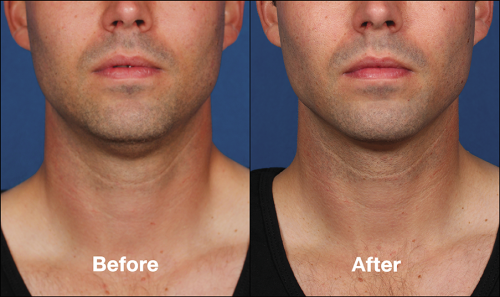 KYBELLA FOR DOUBLE CHIN