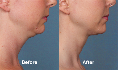 KYBELLA FOR DOUBLE CHIN