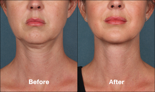 KYBELLA FOR DOUBLE CHIN