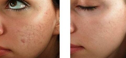 Microfractional Austin Before After