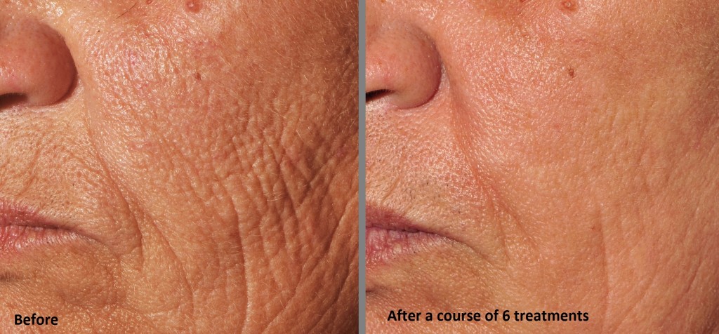 Microfractional Austin Before After