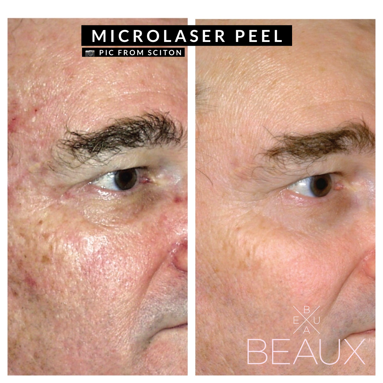 MICROLASER PEEL AUSTIN