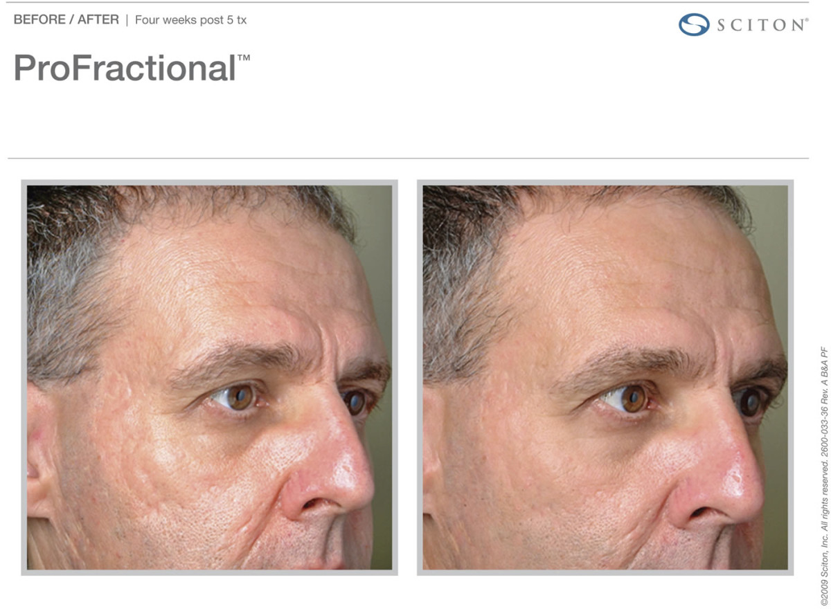 PROFRACTIONAL LASER RESURFACING