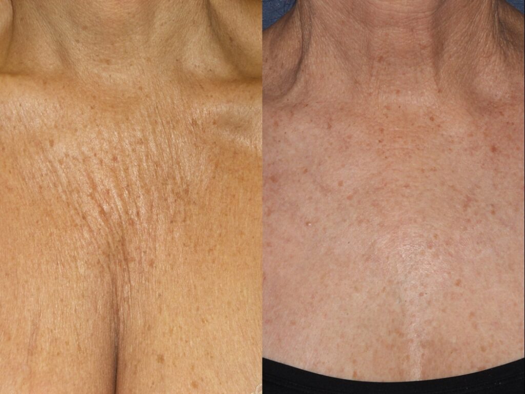 Chest Wrinkles Treatment  Which is Best? What Gets Rid of Deep