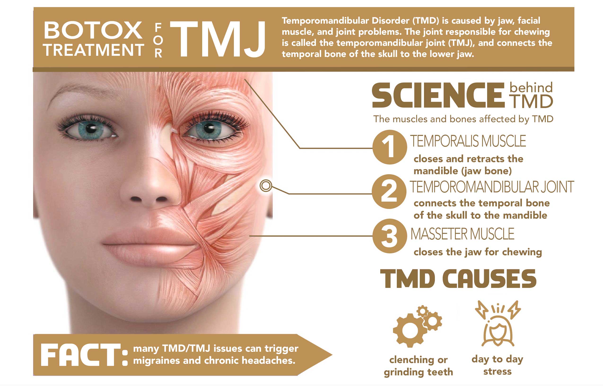 BOTOX for TMJ and MIGRAINES