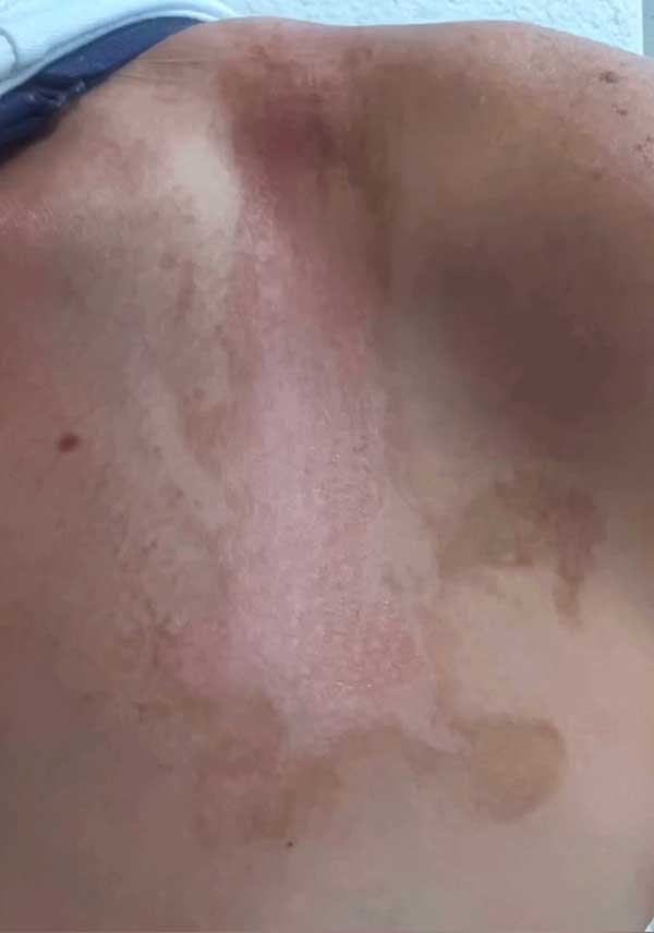 phytophotodermatitis margarita burn