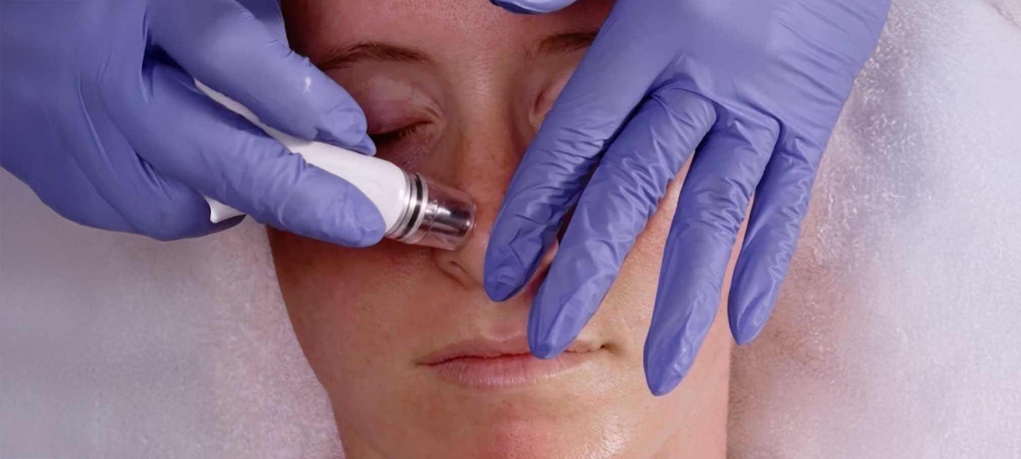 Patient receiving a diamond glow facial at Beaux MedSpa, Benefits of a facial