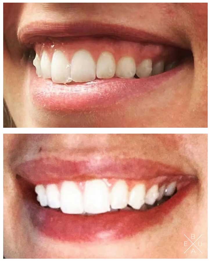 Botox gummy smile in Austin at Beaux MedSpa