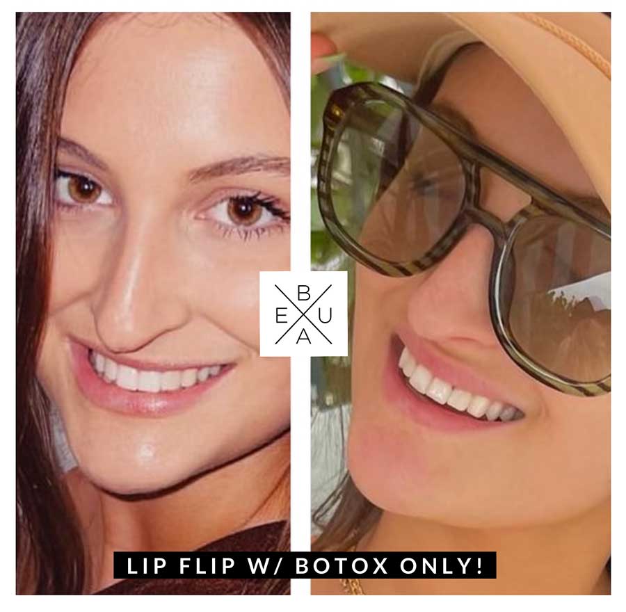 Botox lip flip in Austin at BEAUX MedSpa