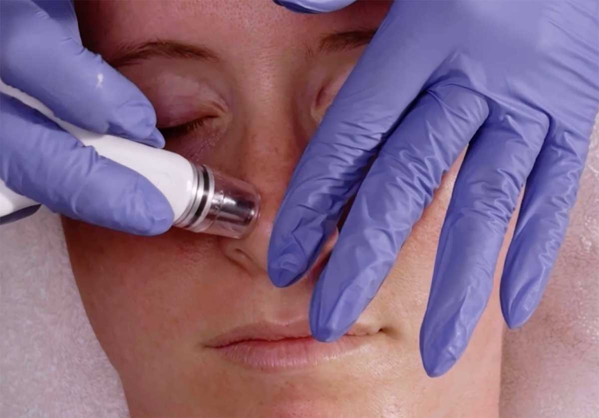 Diamond Glow facial treatment at BEAUX MedSpa in Austin